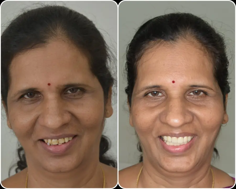 Full-mouth crowns case 5