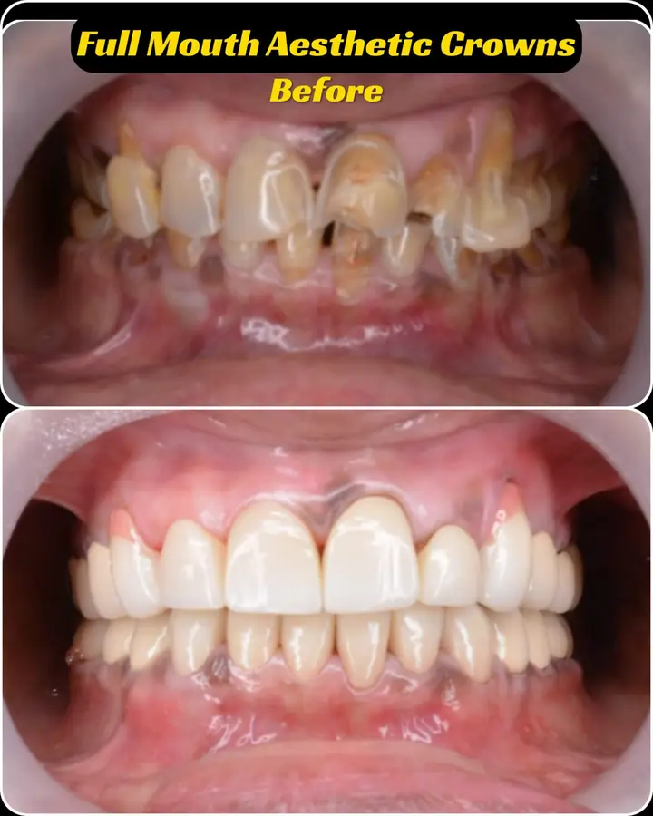 Full-mouth crowns case 7