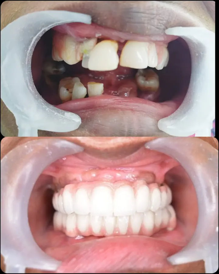 Implant-supported fixed teeth result