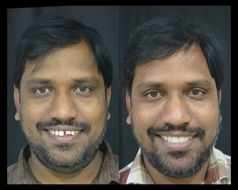 Smile makeover case 1