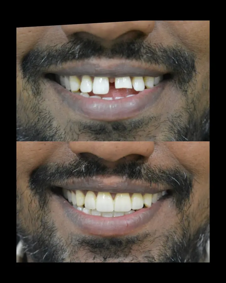 Smile makeover case 3