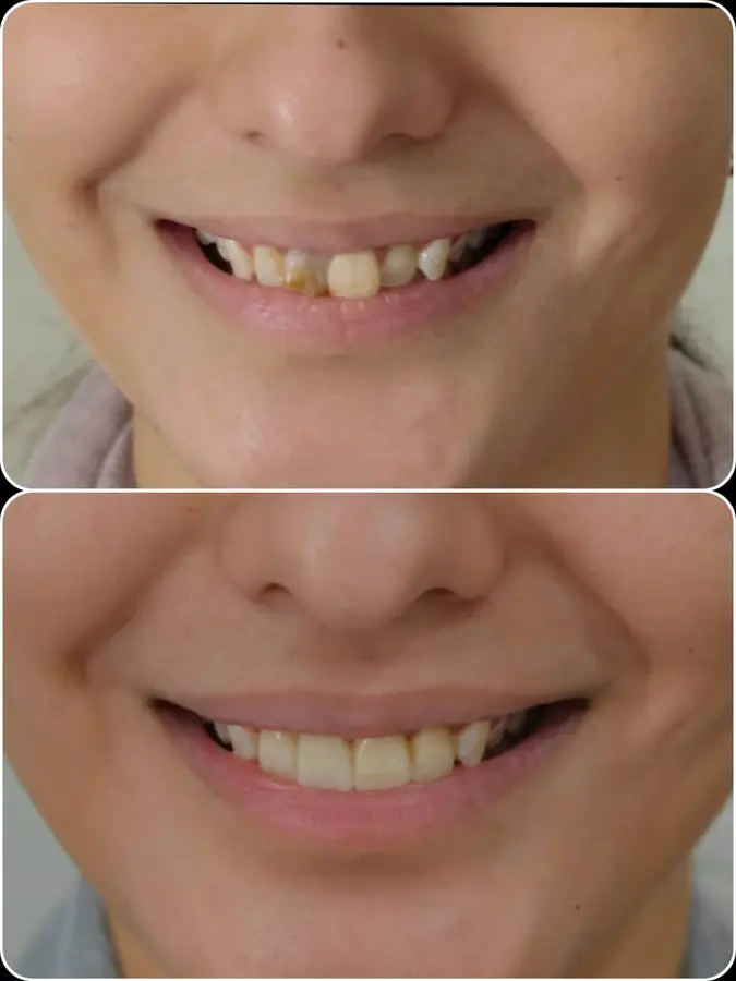Smile makeover case 5