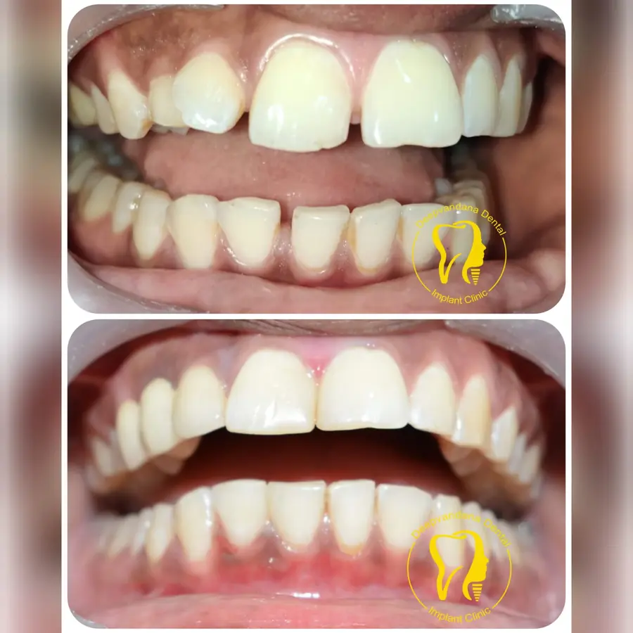 Smile makeover case 10